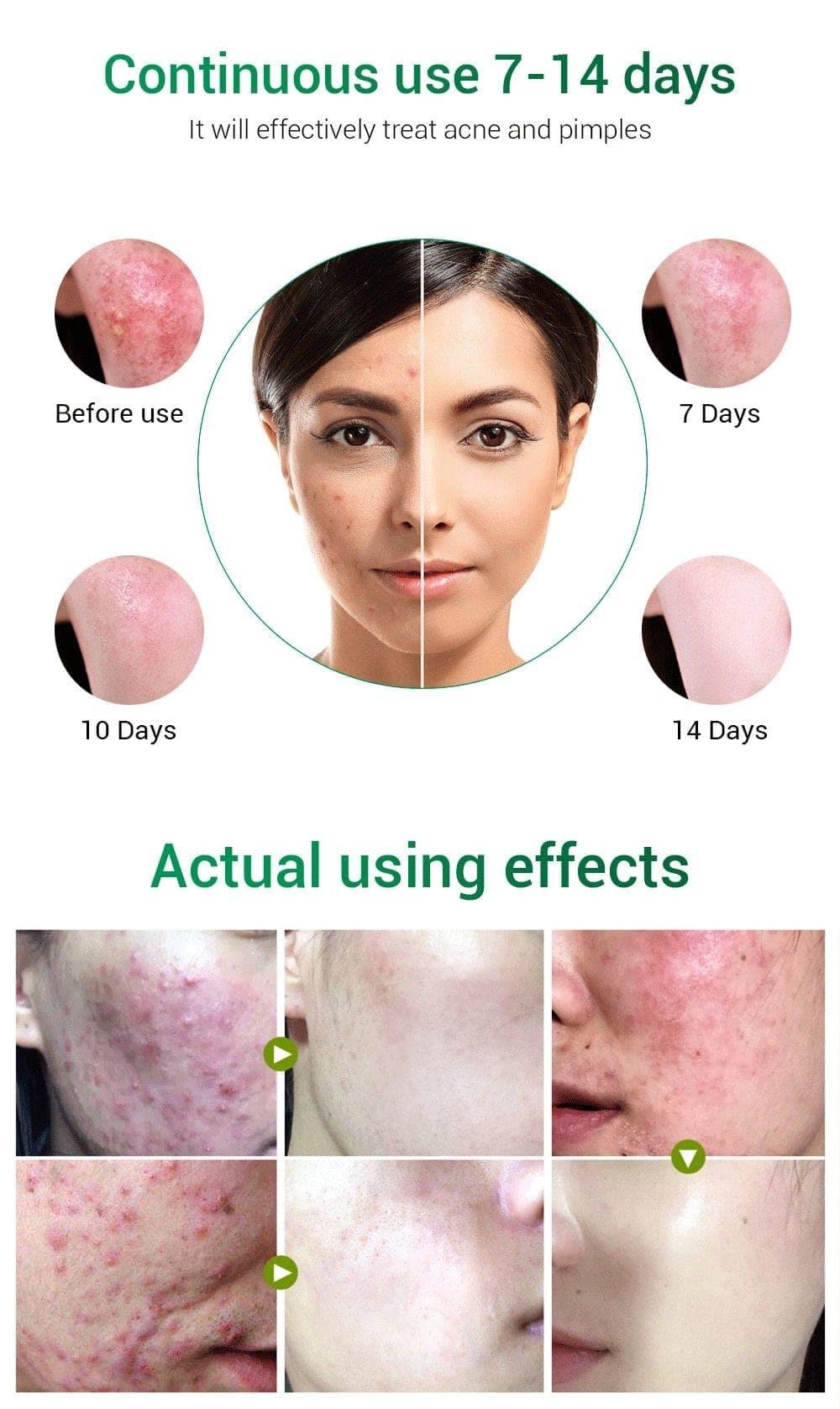 My 7-Day Test with Ammpoure Pimple Patches: Real Results or Just Hype? - Ammpoure Wellbeing
